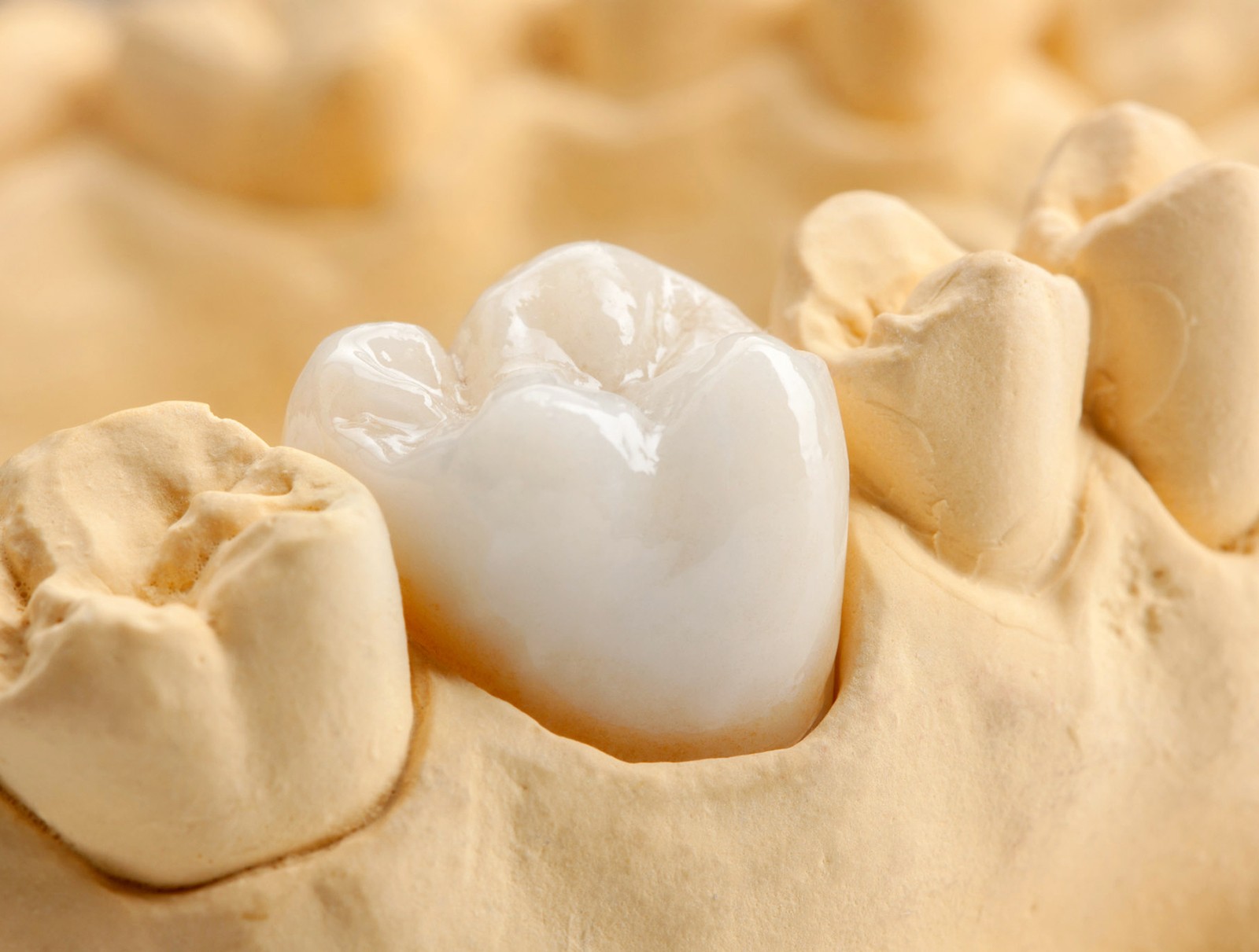 porcelain-dental-crowns-1